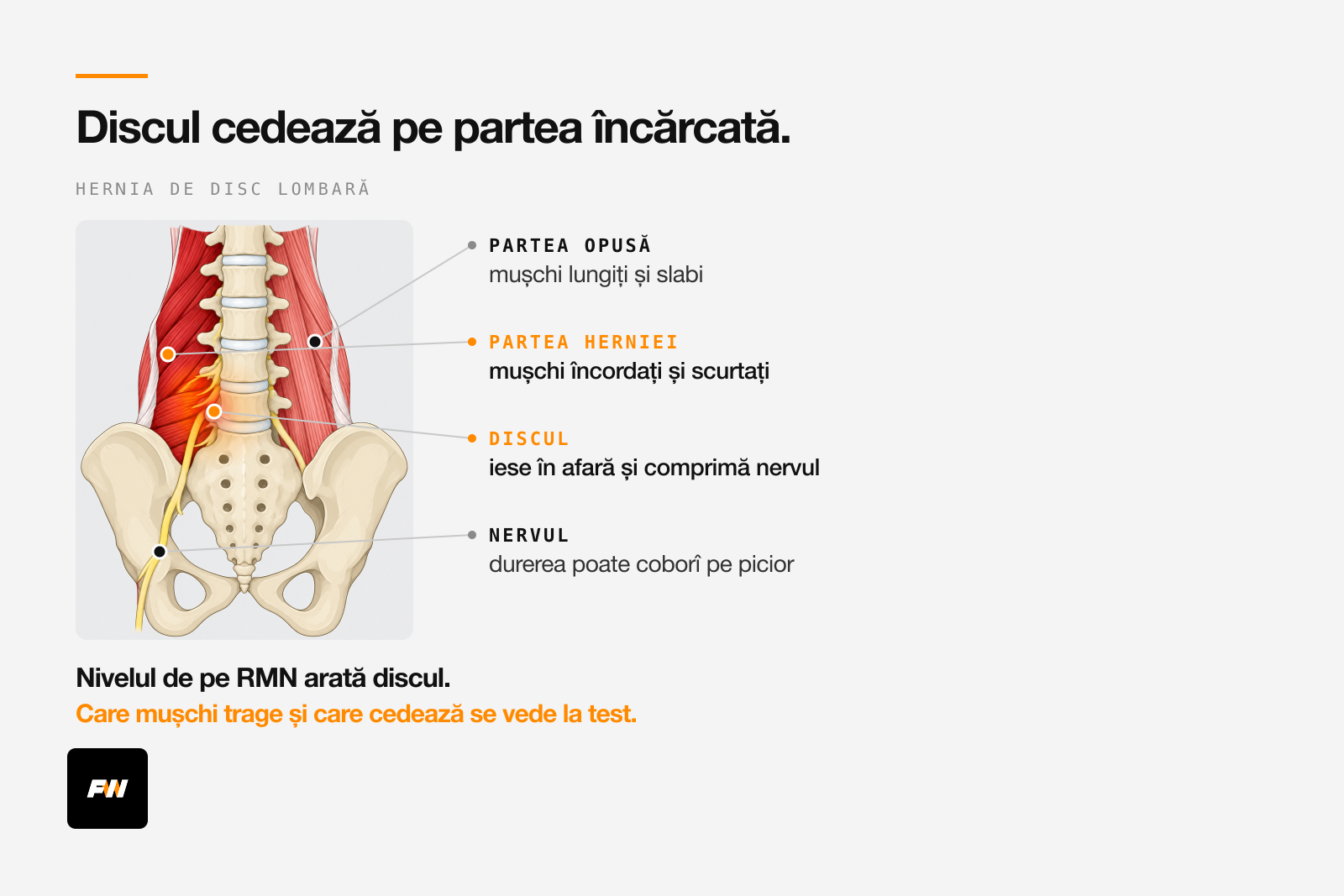 Coloana lombară cu discurile L4-L5 și L5-S1 și presiunea inegală care duce la hernie