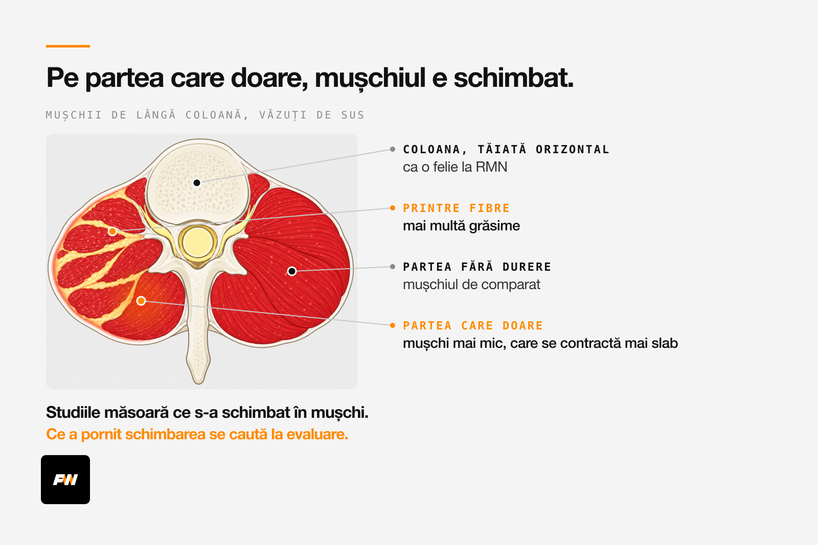 Spatele jos tăiat orizontal, văzut de sus: pe partea care doare, mușchiul de lângă coloană e mai mic și are grăsime printre fibre